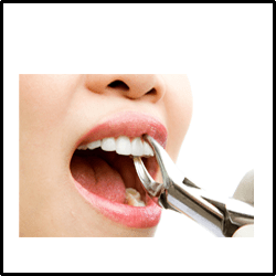 dental extraction