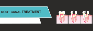 ROOT CANAL TREATMENT