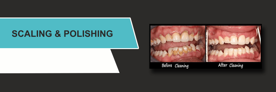 teeth scaling and cleaning