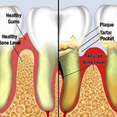 Tooth Decay