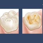 Tooth Erosion