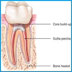 endodontic