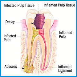 infected tooth