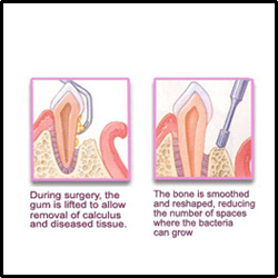 gums surgery
